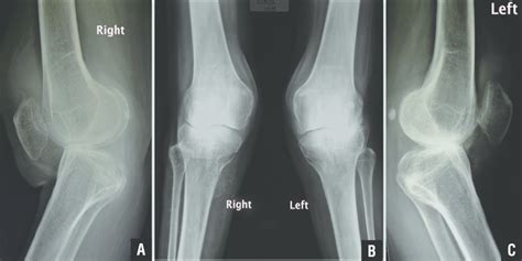 Normal Lateral Knee Radiograph