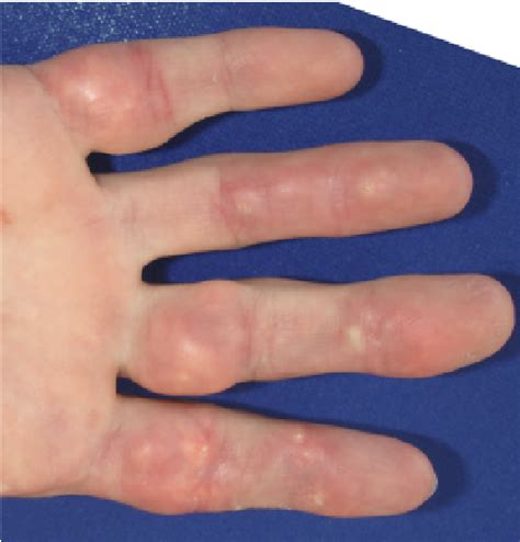 Figure 2 From Calcinosis Cutis Of Juvenile Dermatomyositis Treated With