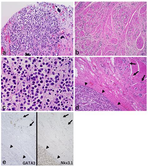 Microscopic Findings A And B The Thickened Lesion In The Urinary Download Scientific Diagram