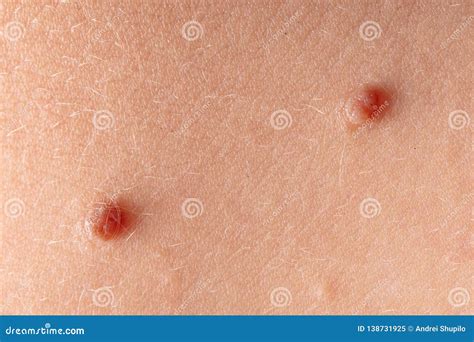 Birthmark On The Skin Of A Person Stock Image Image Of Mark Medicine