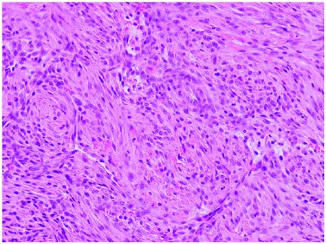 Bland Looking Spindle Cells With Oval Nuclei With Open Chromatin And