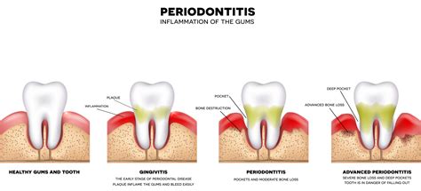 What Are The Signs And Symptoms Of Periodontal Disease Implant