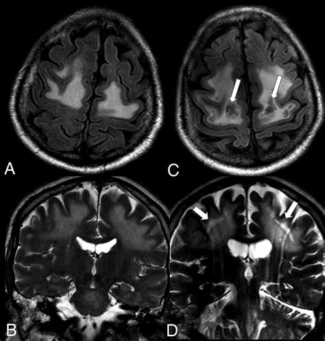 Serial Imaging Of Virus Associated Necrotizing Disseminated Acute