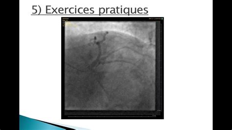 AsPeCaF 2019 Exposé 10 Tommy SGUERA Incidences radiologiques en