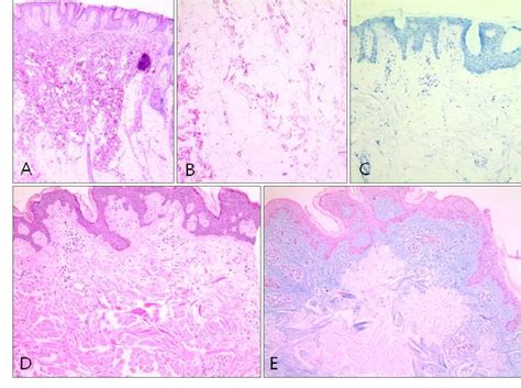 Figure 2 from A Case of Acquired Mucinous Nevus in Nevus Lipomatosus ...