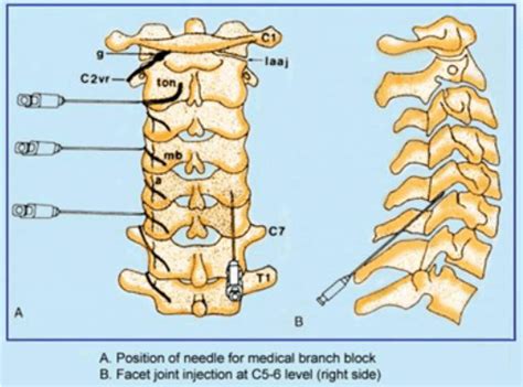 Treatment of neck pain - cervical facet joint pain - Pain Treatment and ...