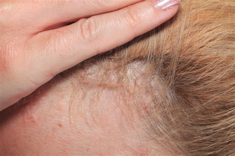 Scalp Psoriasis Symptoms Causes And Treatment