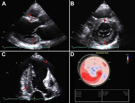 Practical Points For Echocardiography In Cardiac Amyloidosis Journal