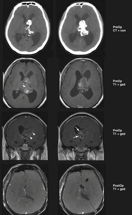 Cerebellopontine Angle Tumors | Neupsy Key