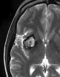 Susceptibility Artifact Questions And Answers In Mri