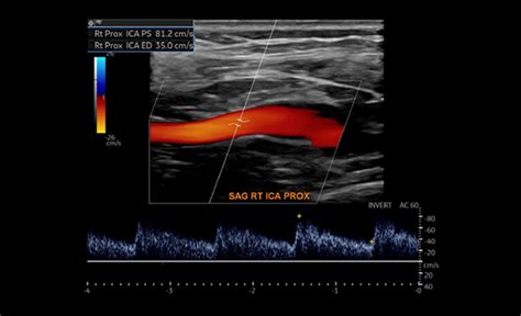 Types of Vascular Ultrasounds - Vascular Health