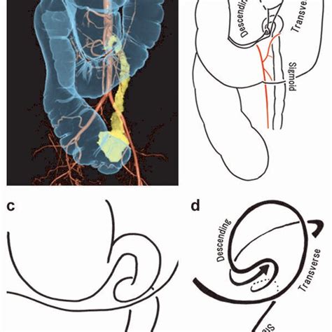 Abdominal Radiography After Endoscopic Detorsion A Gastrografin Enema