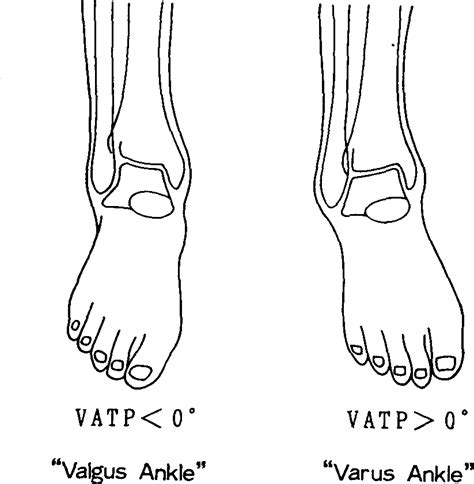 Valgus Vs Varus Of Ankle