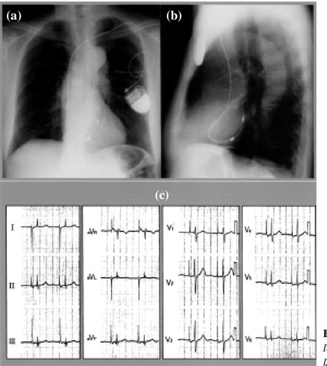 Figure 2 From Journal Of The Hong Kong College Of Cardiology Semantic