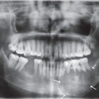 Orthopantomogram OPG Shows A Well Defined Multilocular Radiolucency