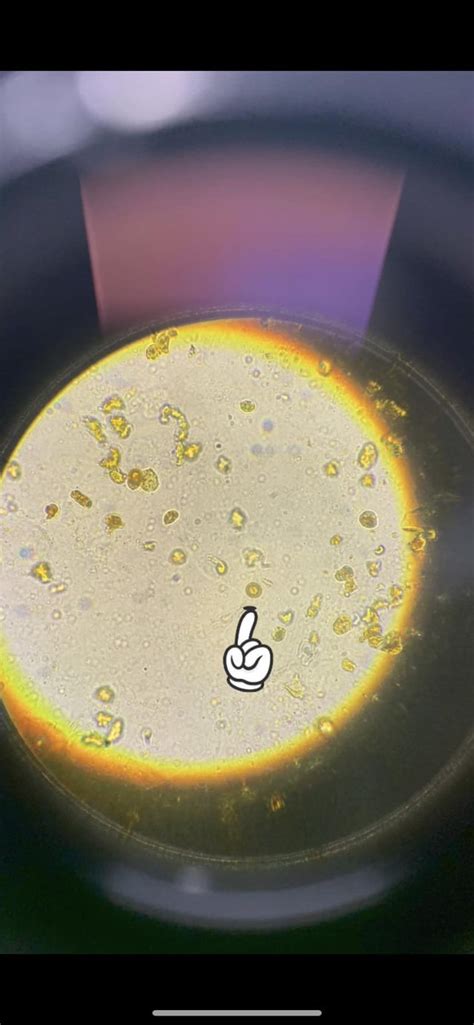 Potential leucine crystals. Patient is jaundice w/pancreatic cancer ...