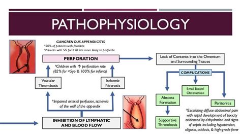 Pathophysiology Of Acute Appendicitis