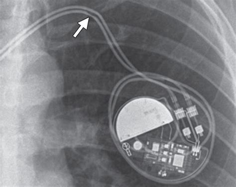 Radiography Of Cardiac Conduction Devices A Comprehensive Review