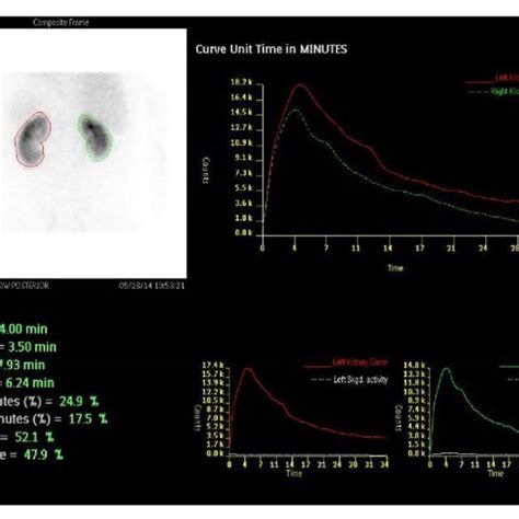 Mercaptoacetyltriglycine (MAG3) scan demonstrating good drainage of the ...