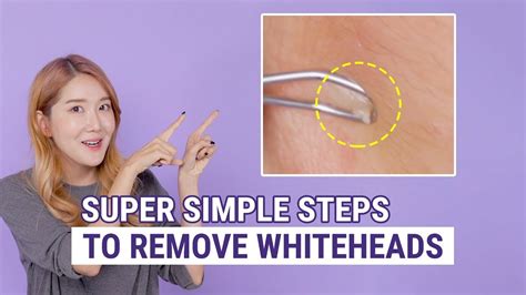 How To Remove Whiteheads The Best Whitehead Removal And Prevention Box