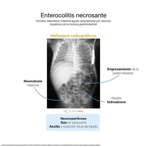 Enterocolitis Necrosante Pediatría Medicina Estudiante de medicina