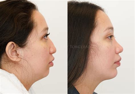 Submental Liposuction Before After Gallery Dr Cory Torgerson