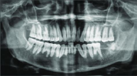 Panoramic Radiograph Showing A Multilocular Radiolucency Extending From