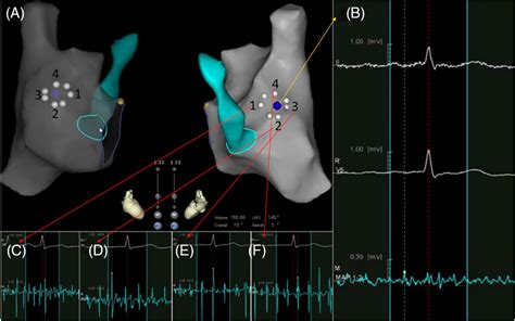 Zerofluoroscopy Transseptal Puncture Guided By Right Atrial