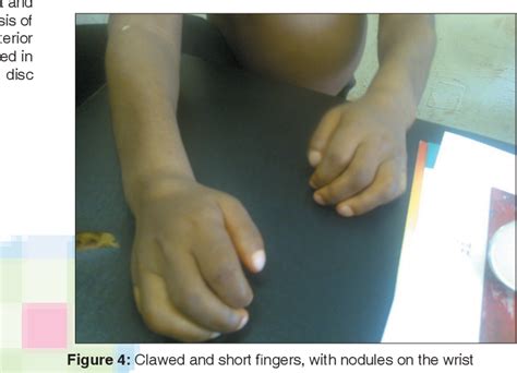 Figure From Clinical Presentation Of Mucopolysaccharidosis Type Ii