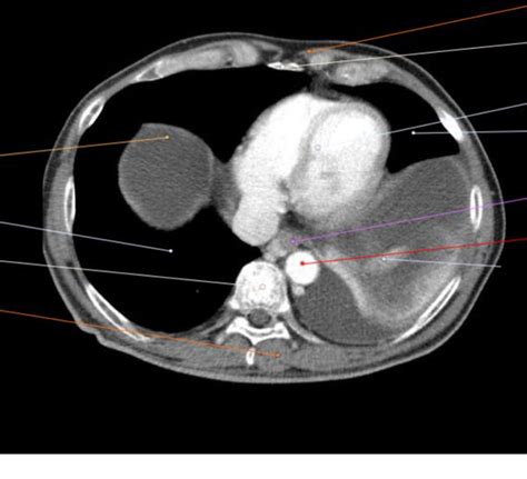 Diagram Of Peritoneal Cavity Male 2 Quizlet