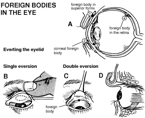 Foreign Body Removal from Eye - Eye Health Nepal