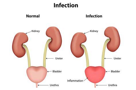 Urinary Tract Infection During Pregnancy