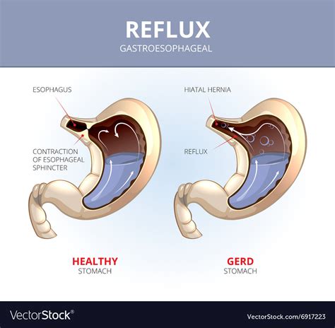 Gastroesophageal Reflux Disease