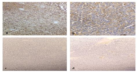 Intra Oral Plasma Cell Neoplasm A Case Report Auctores