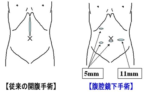 腹腔鏡下手術について｜医療法人慶仁会 城山病院