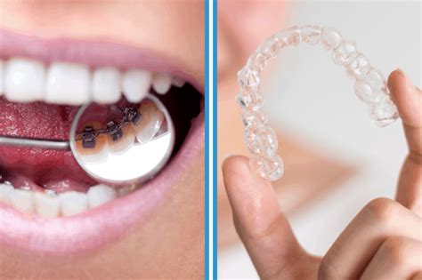 Lingual Braces Vs Invisalign Blog Swansea Dental Practice