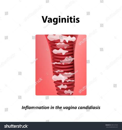 Vaginitis Inflammation Vagina Candidiasis Thrush Infographics Immagine Vettoriale Stock