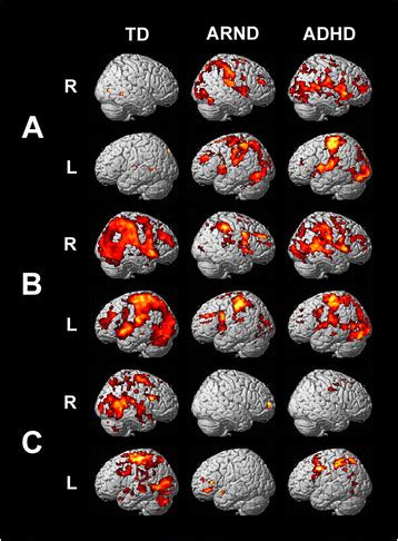 Mri Activation Maps Fmri Activation Maps For A The Disjunction