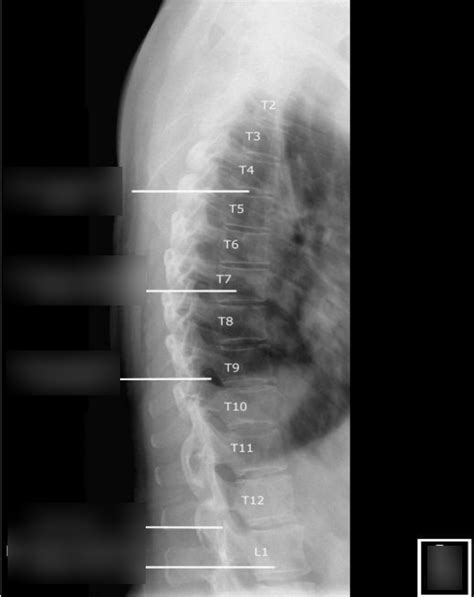 Diagram X Ray Of Lateral Thoracic Spine Diagram Quizlet