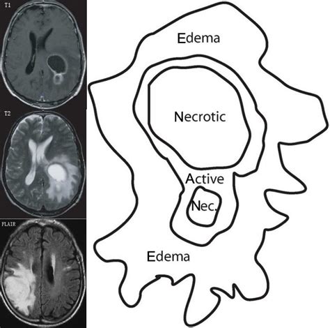 Brain Mri Tumor