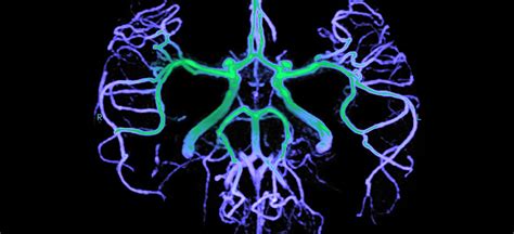 Angiography | Conditions & Treatments | UT Southwestern Medical Center