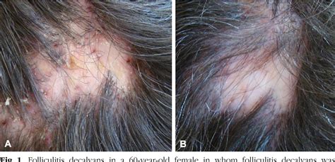 Figure 1 From Folliculitis Decalvans Effectiveness Of Therapies And