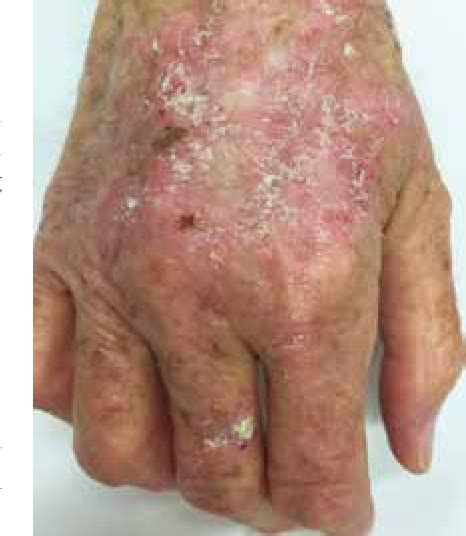 Figure 2 From A GPs Guide To Actinic Keratosis Semantic Scholar