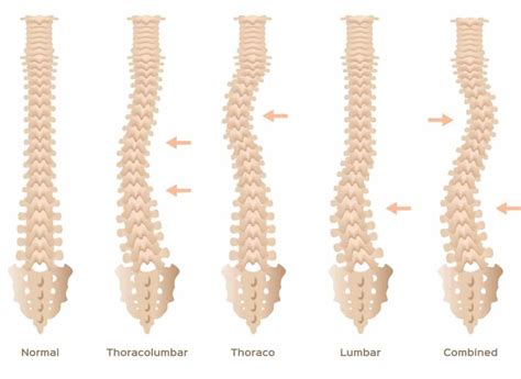 Skoliose Symptome Ursachen und Therapiemöglichkeiten Heilpraxis