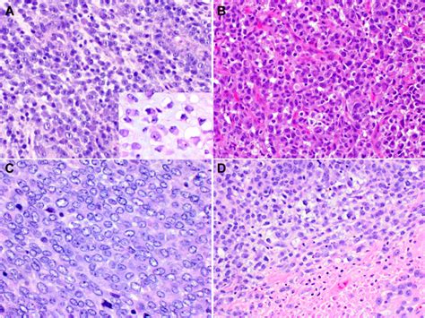 Alk Rearranged Epithelioid Mesenchymal Neoplasm Expanding The Spectrum