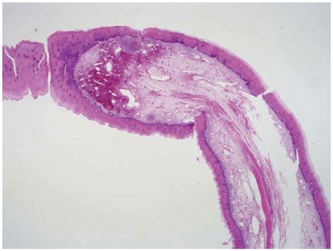 Histopathological Features Of The Fibrovascular Polyp The Core Of The