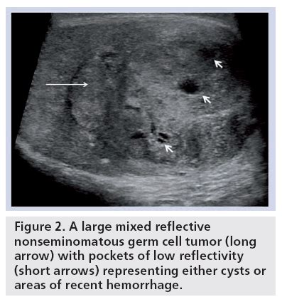 Testicular Tumor Ultrasound