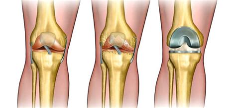 Total Joint Replacement | Orange County Orthopedic Center