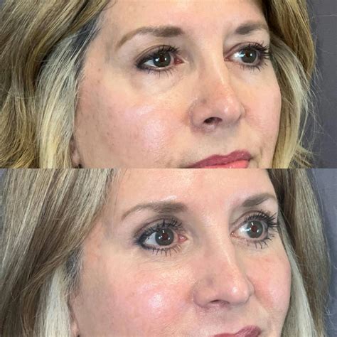 Patient 354981 Laser Resurfacing Before And After Photos Austin Face And Body