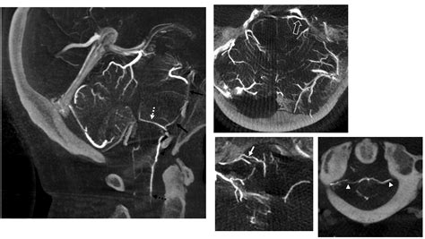 Index of /wp-content/uploads/Venous/Posterior_Fossa_Veins